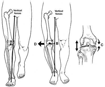 Bowed Legs and Knee Arthritis Figure 1