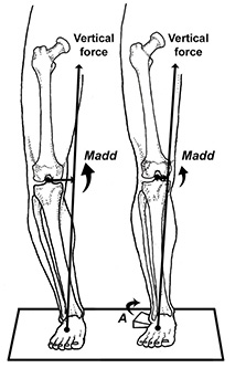 Bowed Legs and Knee Arthritis Figure 2