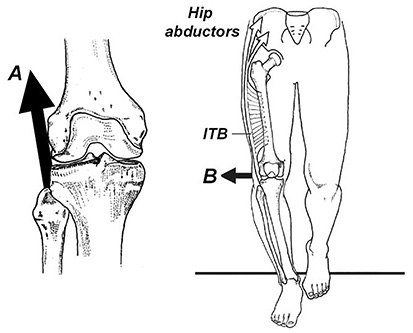 Bowed Legs and Knee Arthritis Figure 3