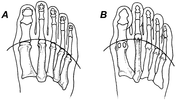 An elongated second metatarsal An elongated second metatarsal