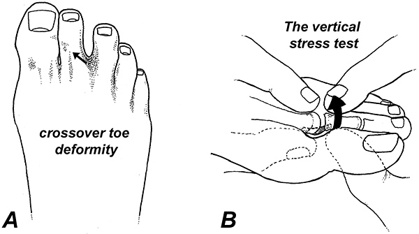Toe positions with a plantar plate rupture Toe positions with a plantar plate rupture
