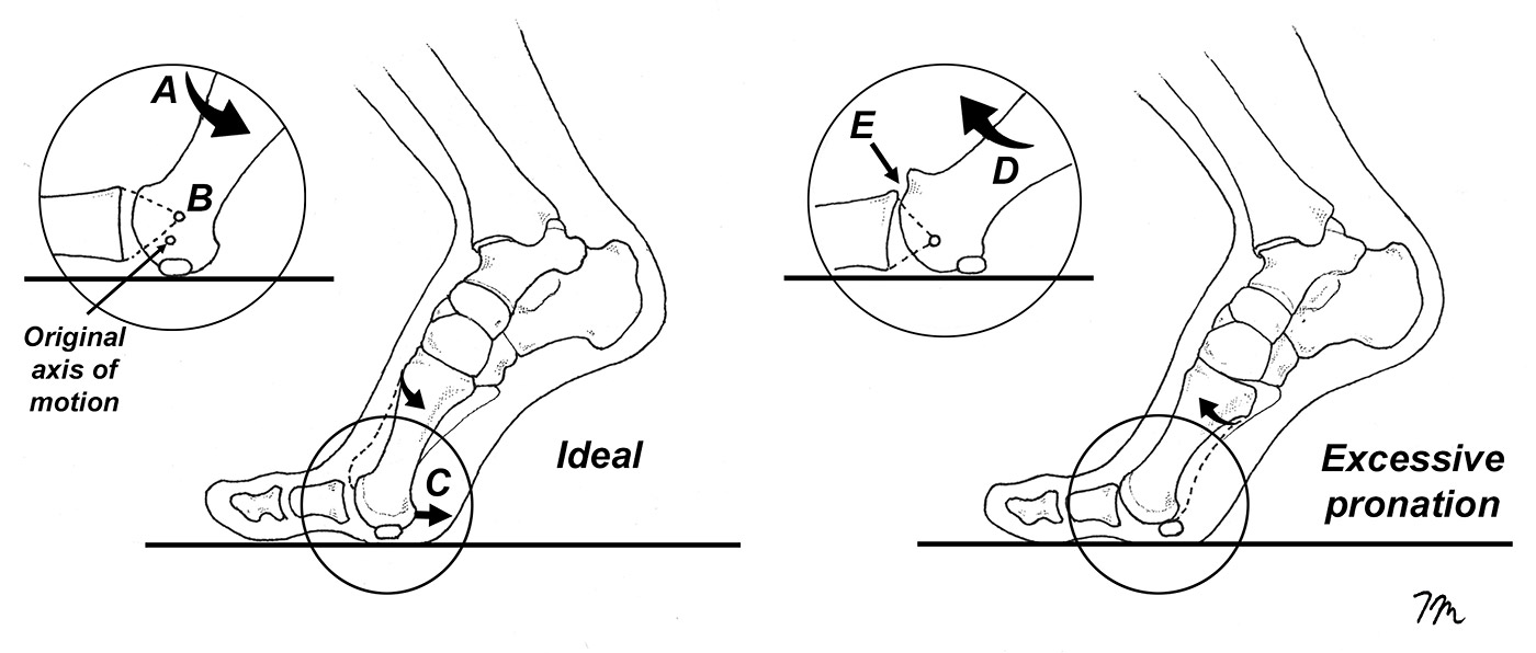 functional hallux limitus