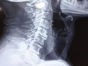 thyroid cartilage x ray