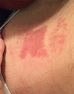 Anybody know what rash this is? It's on my lower back right above my  underwear line and it's itchy : r/DermatologyQuestions