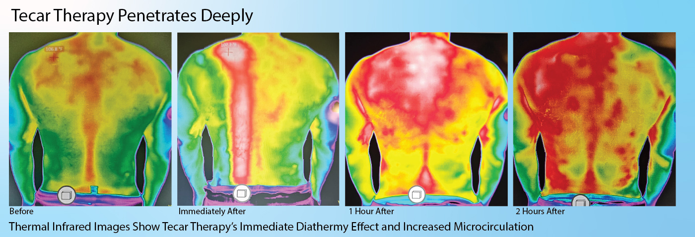 monopolar radiofrequency (RF) energy