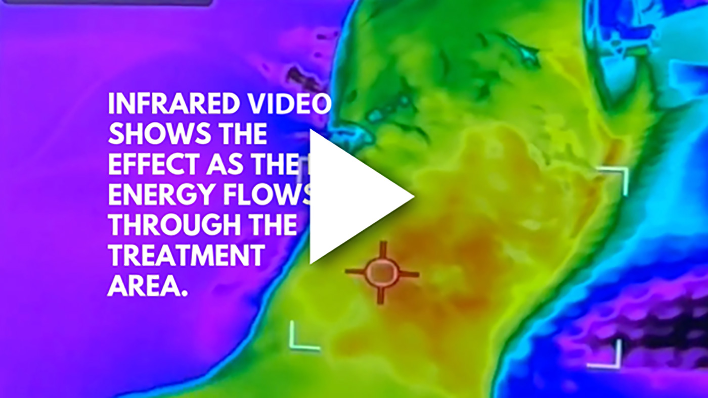 Infrared video shows the effect as the energy flows through the treatment area