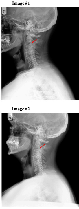 X-ray Findings X-ray Findings