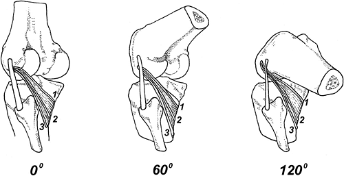 Popliteus Tendinitis