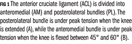 FIG 1 The anterior cruciate ligament (ACL) is divided into anteromedial (AM) and posterolateral bundles (PL). The pos...