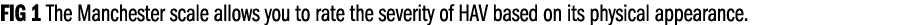 FIG 1 The Manchester scale allows you to rate the severity of HAV based on its physical appearance.