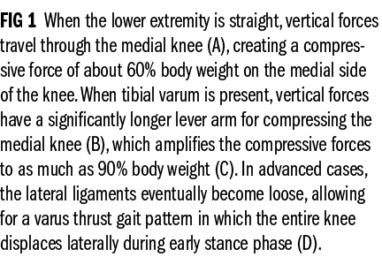 FIG 1 When the lower extremity is straight, vertical forces travel through the medial knee (A), creating a compressiv...