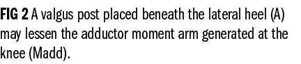 FIG 2 A valgus post placed beneath the lateral heel (A) may lessen the adductor moment arm generated at the knee (Madd).