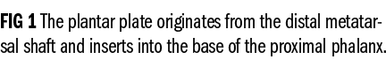 FIG 1 The plantar plate originates from the distal metatarsal shaft and inserts into the base of the proximal phalanx. 