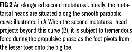 FIG 2 An elongated second metatarsal. Ideally, the metatarsal heads are situated along the smooth parabolic curve ill...