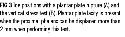 FIG 3 Toe positions with a plantar plate rupture (A) and the vertical stress test (B). Plantar plate laxity is presen...