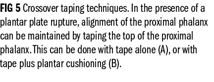 FIG 5 Crossover taping techniques. In the presence of a plantar plate rupture, alignment of the proximal phalanx can ...