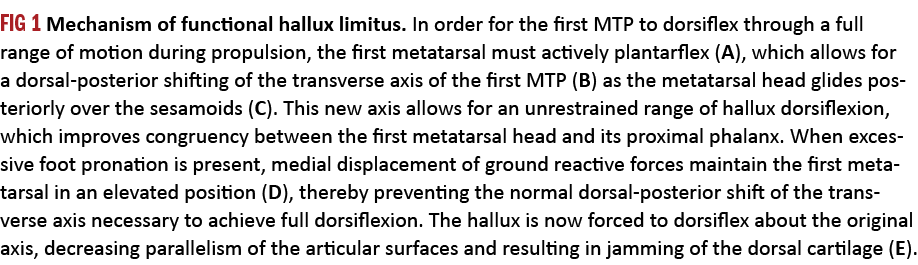 FIG 1 Mechanism of functional hallux limitus. In order for the first MTP to dorsiflex through a full range of motion ...