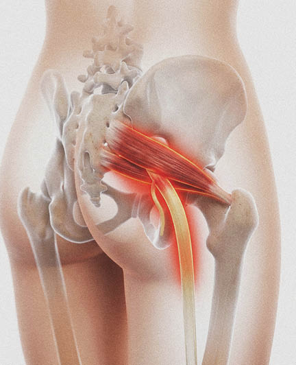 Anatomical visualization sciatic nerve entrapment by piriformis muscle inside female pelvis representing piriformis syndrome chronic pain compression clinical medical science
