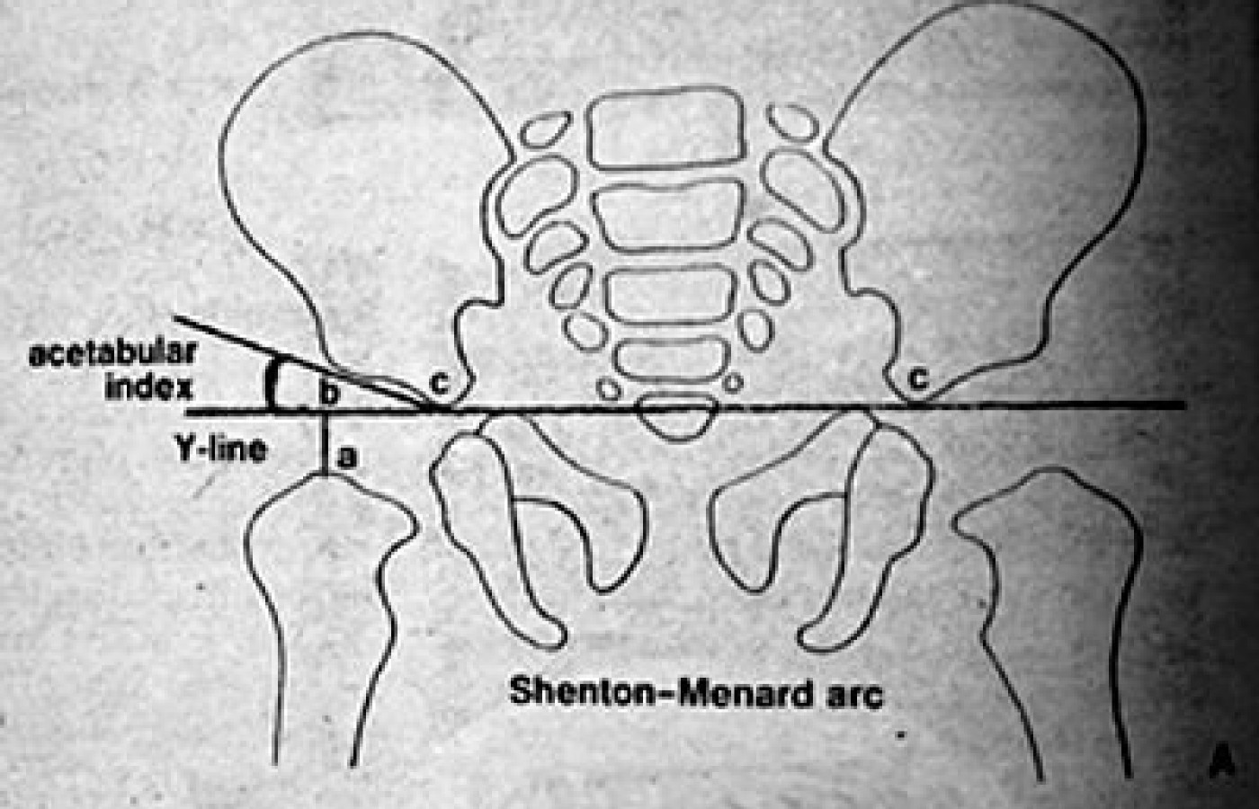 Shenton-Menard arc
