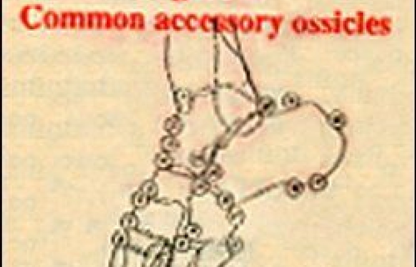 Common accessory ossicles