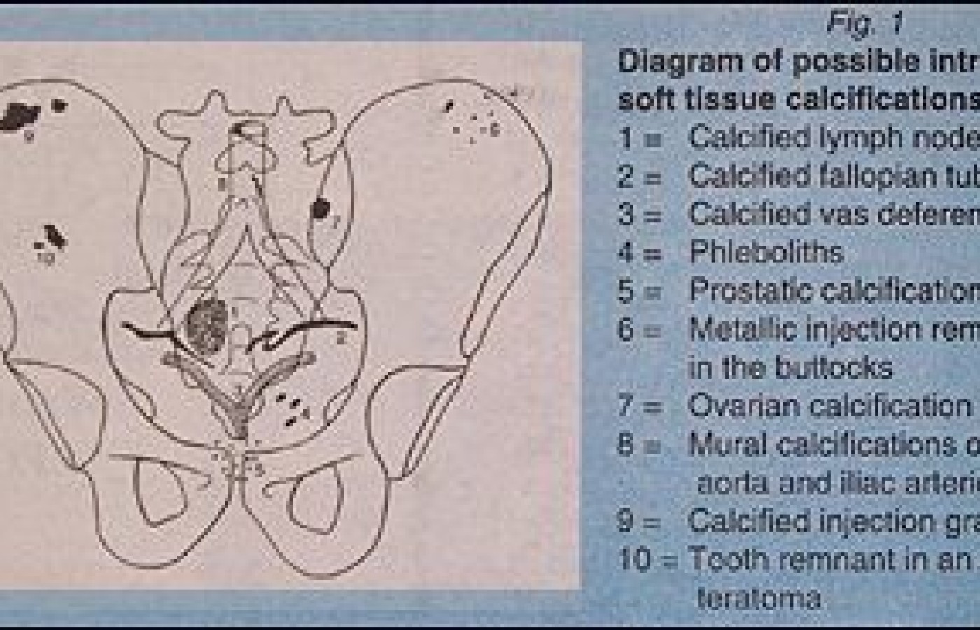 Diagram of possible Intrapelvic soft tissue calcifications