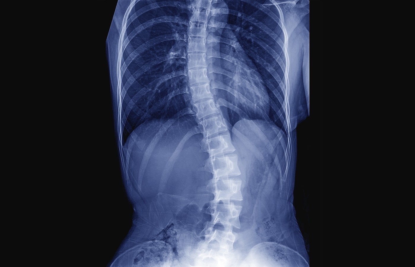 Adolescent Idiopathic Scoliosis