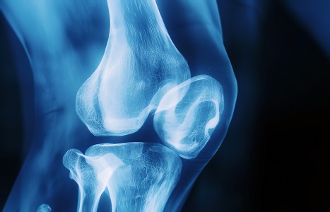 Bowed Legs and Knee Arthritis