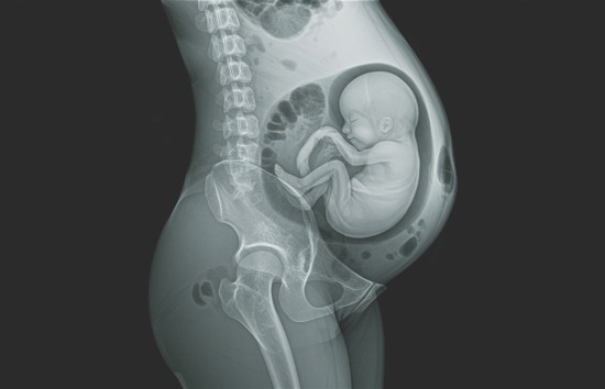 Managing Pregnancy-Related Pelvic Girdle Pain
