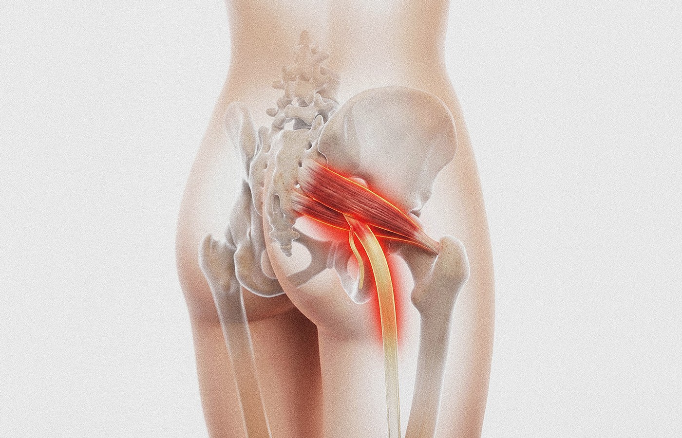 When Radiculopathy Isn’t Radiculopathy