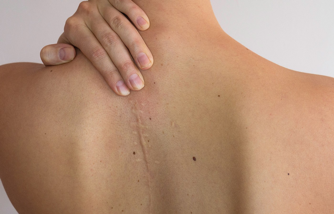 Scars Are Fascia Events, Too
