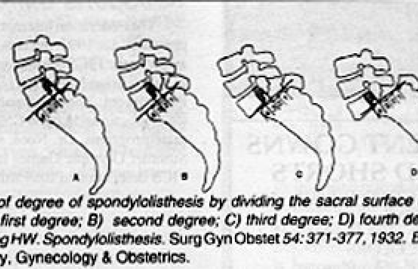 Grading of degree of spondylolisthesis