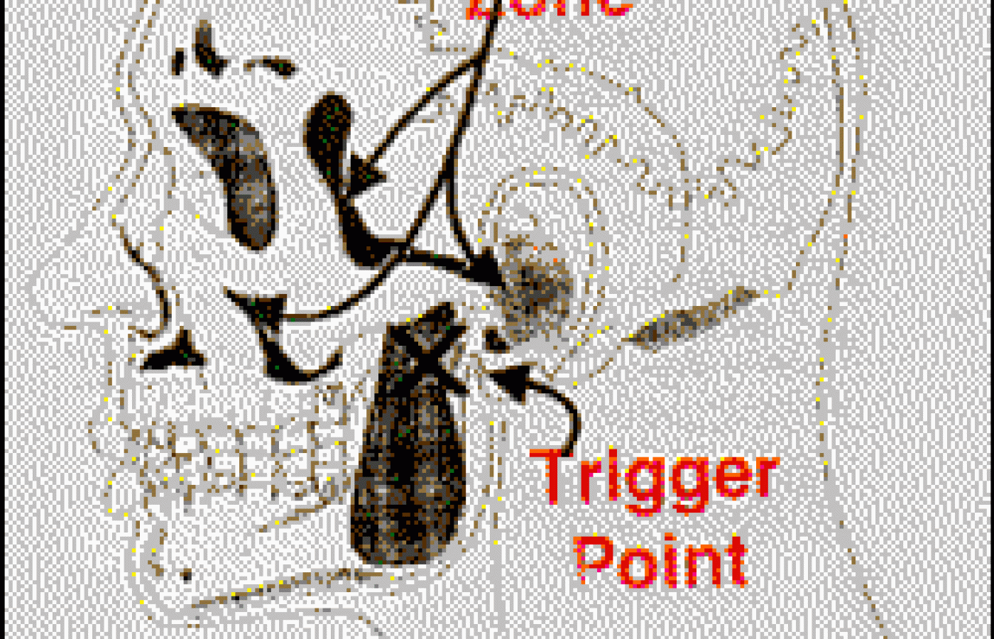 Referral Zone and Trigger Point Diagram
