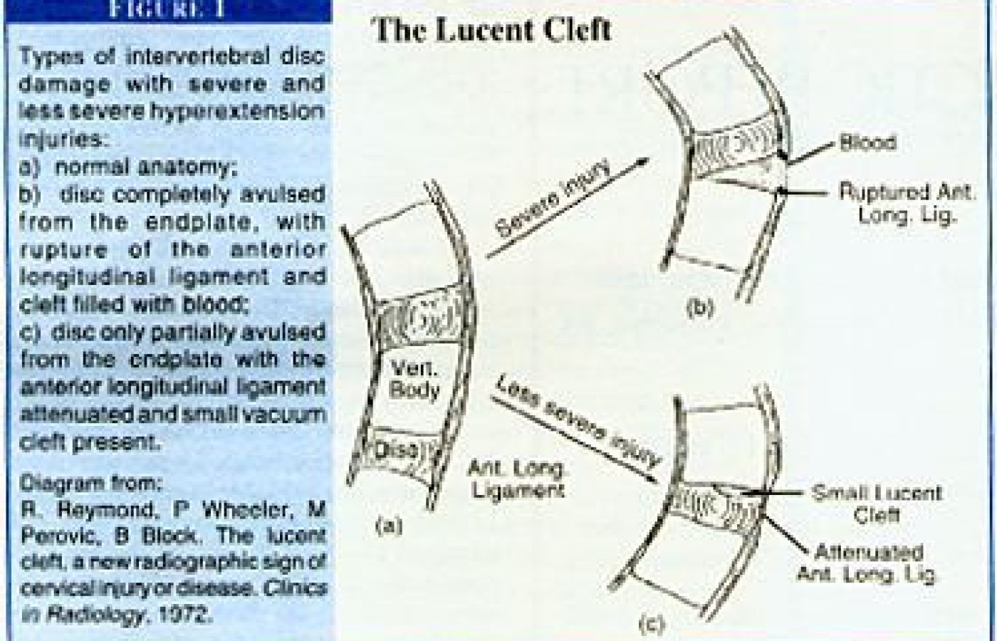 The Lucent Cleft