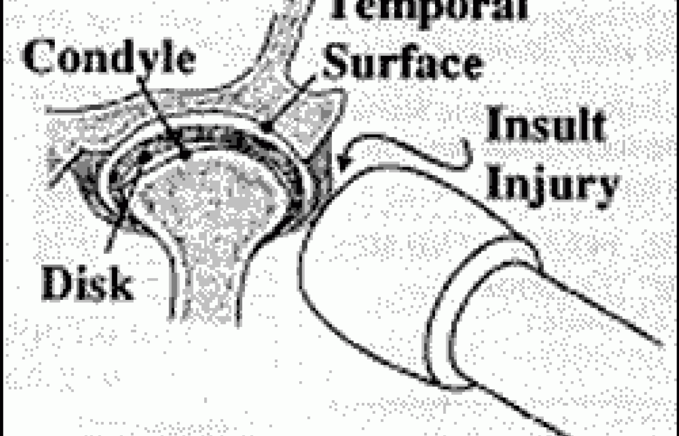 TMJ Adjustment Diagram 1