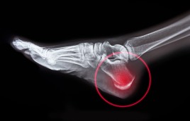 Heel Pain: More Than Plantar Fasciitis