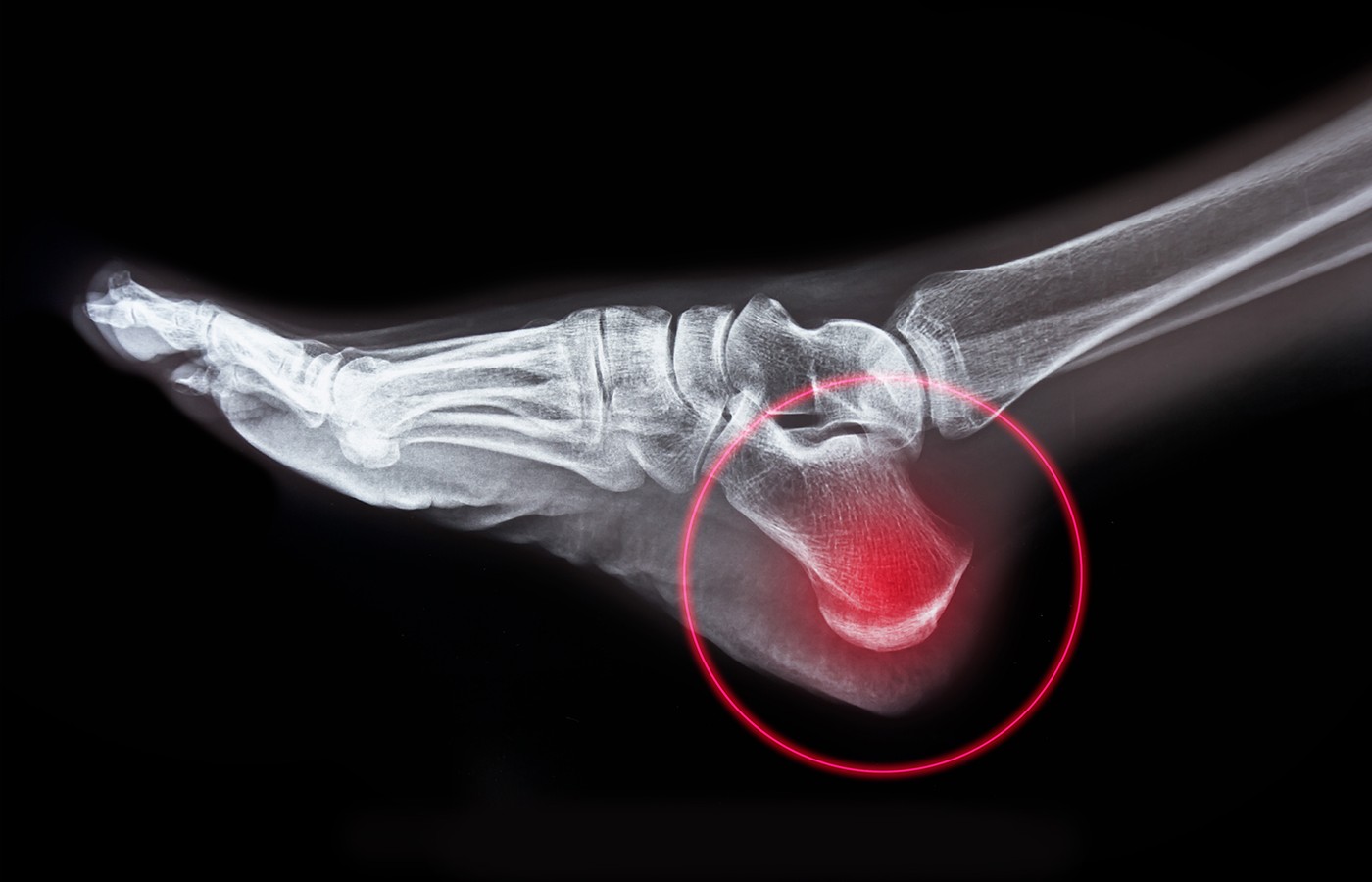 Heel Pain: More Than Plantar Fasciitis