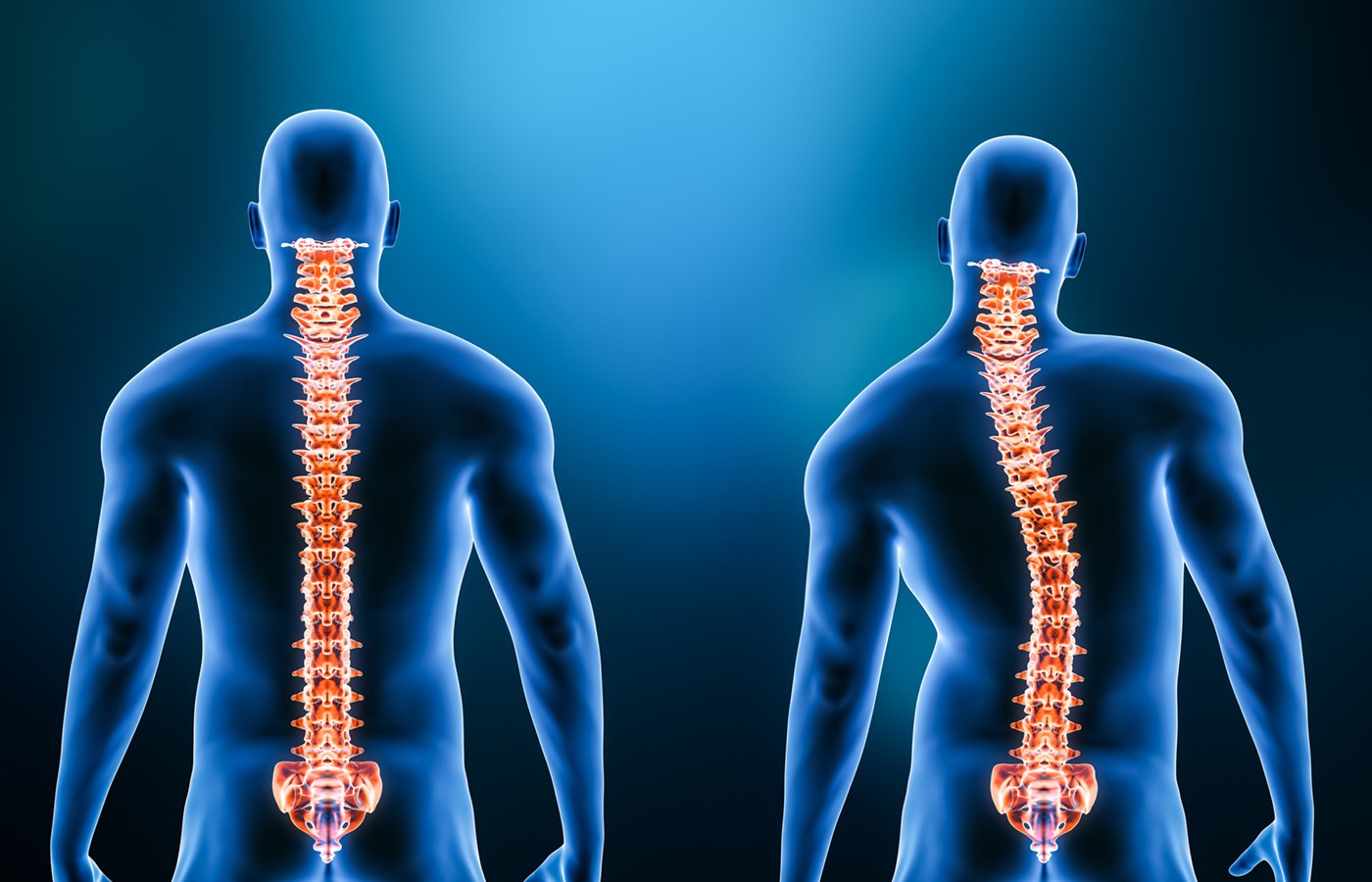 Scoliosis: Finding Motion