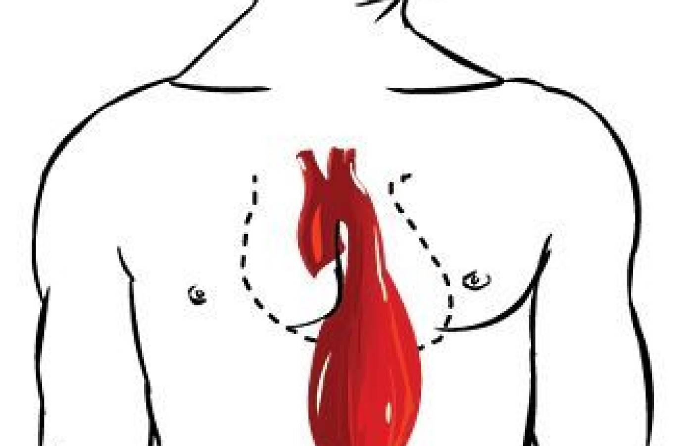 Aortic Aneurysm