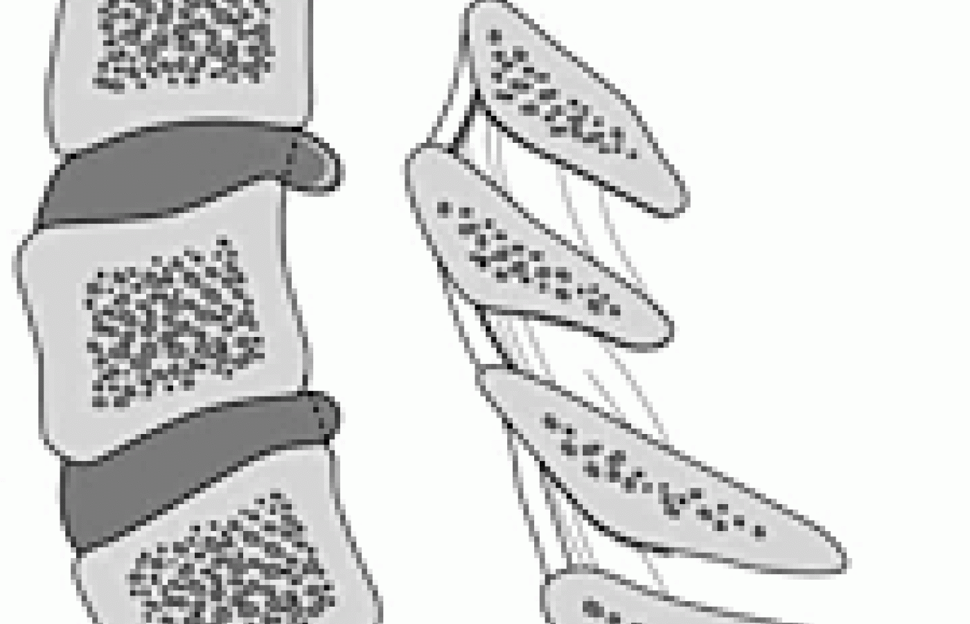 Three common lesions of the intervertebral disc.