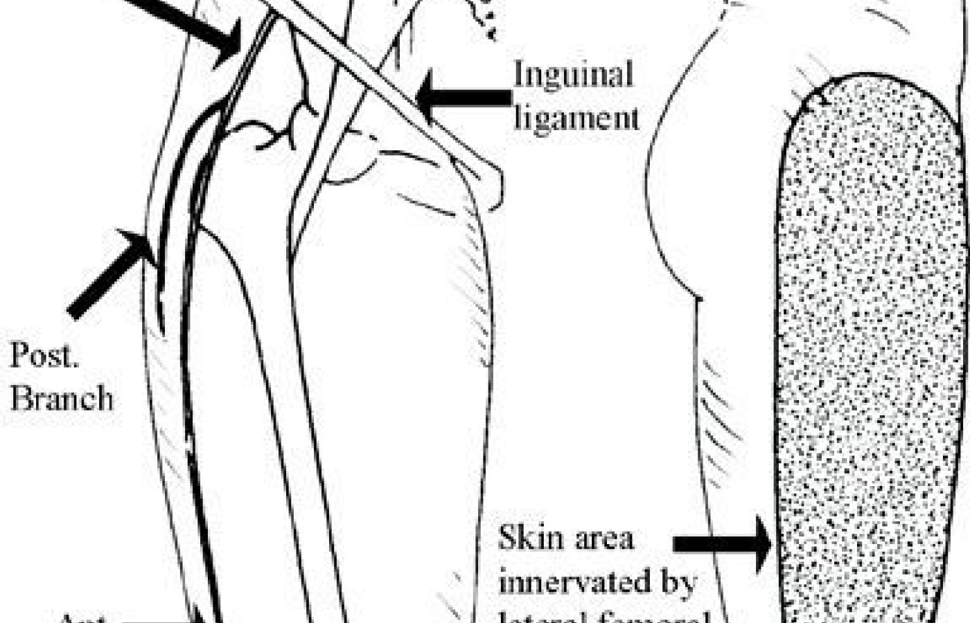 Lateral Femoral Cutaneous Nerve