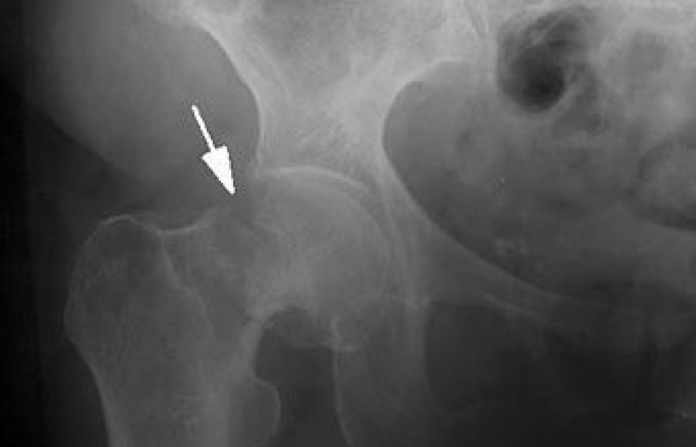 neck of femur fracture