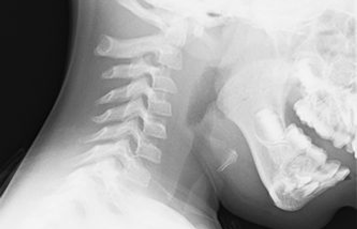 cervical flexion radiograph