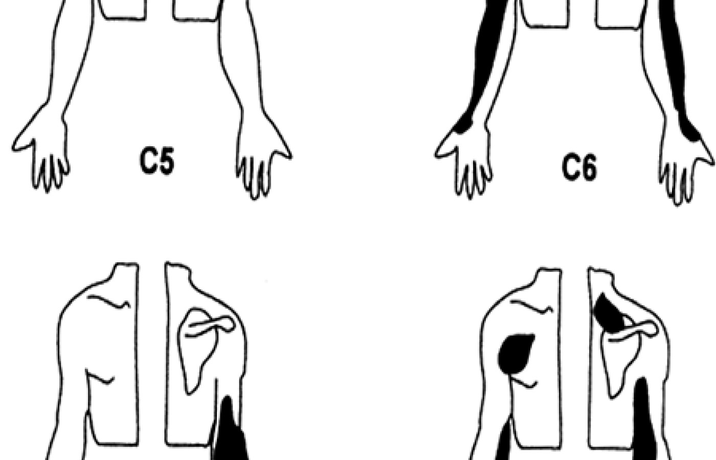 cervical interspinal ligaments