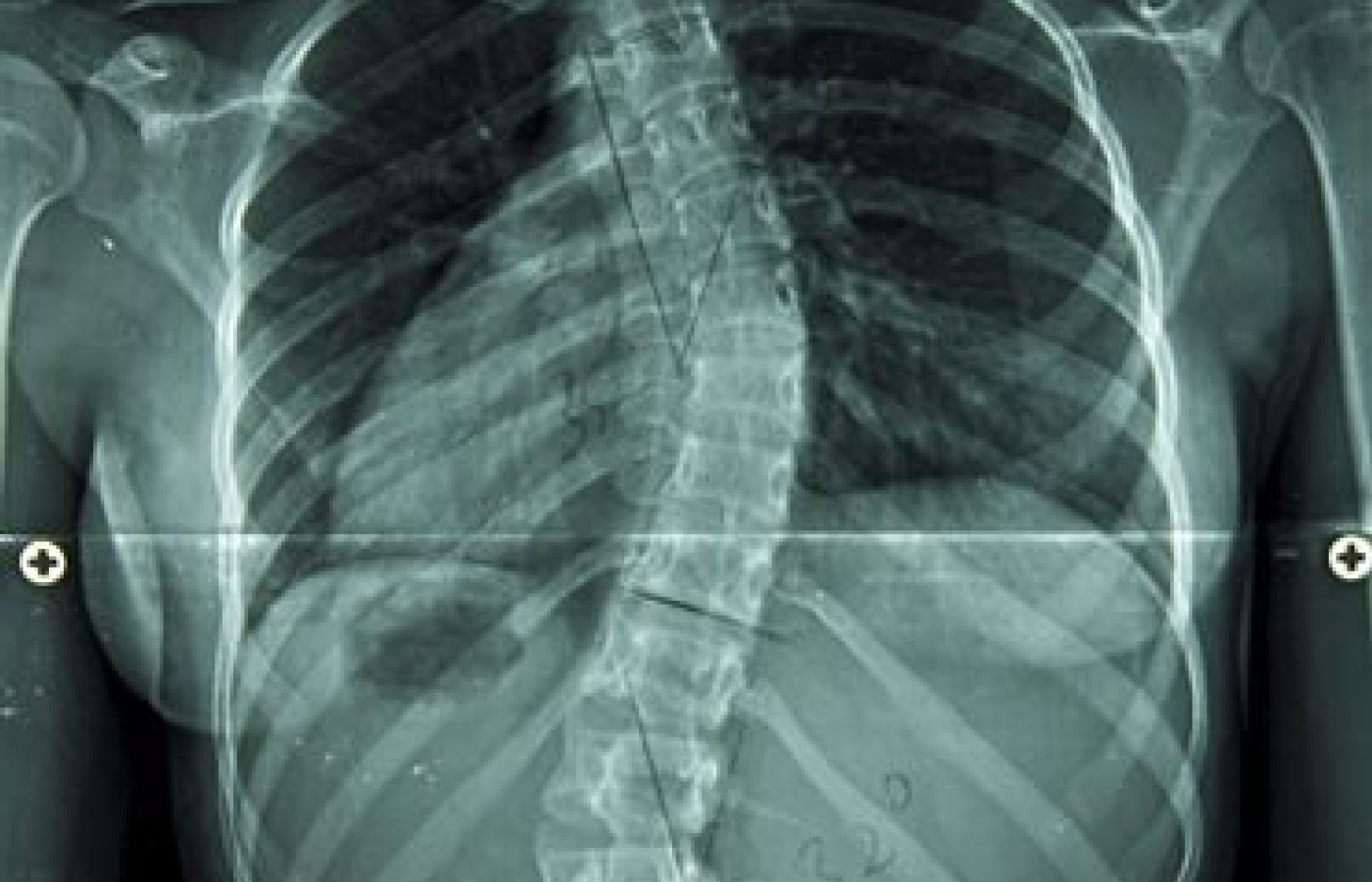 Idiopathic Scoliosis