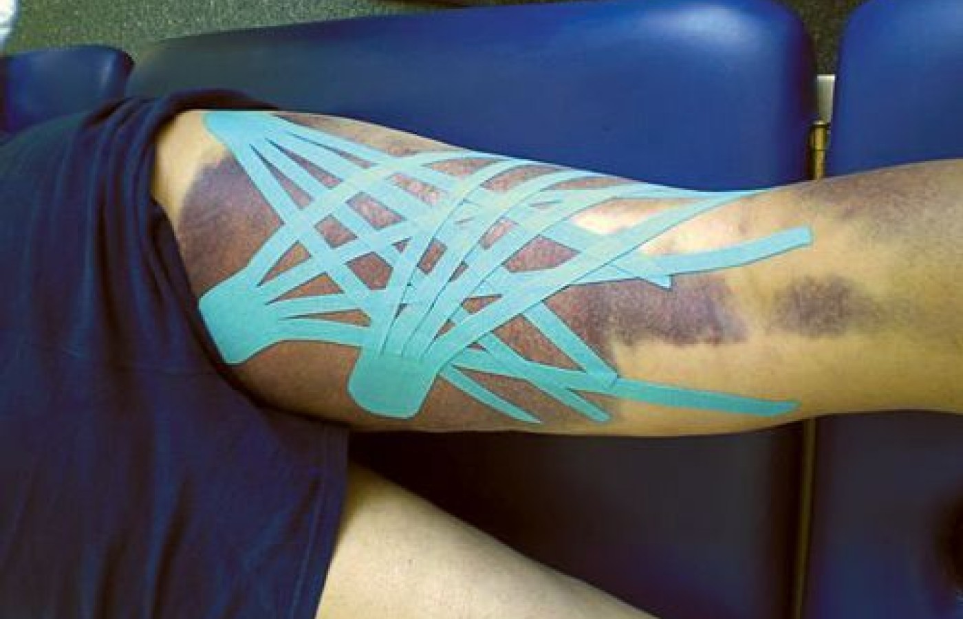 kinesio taping