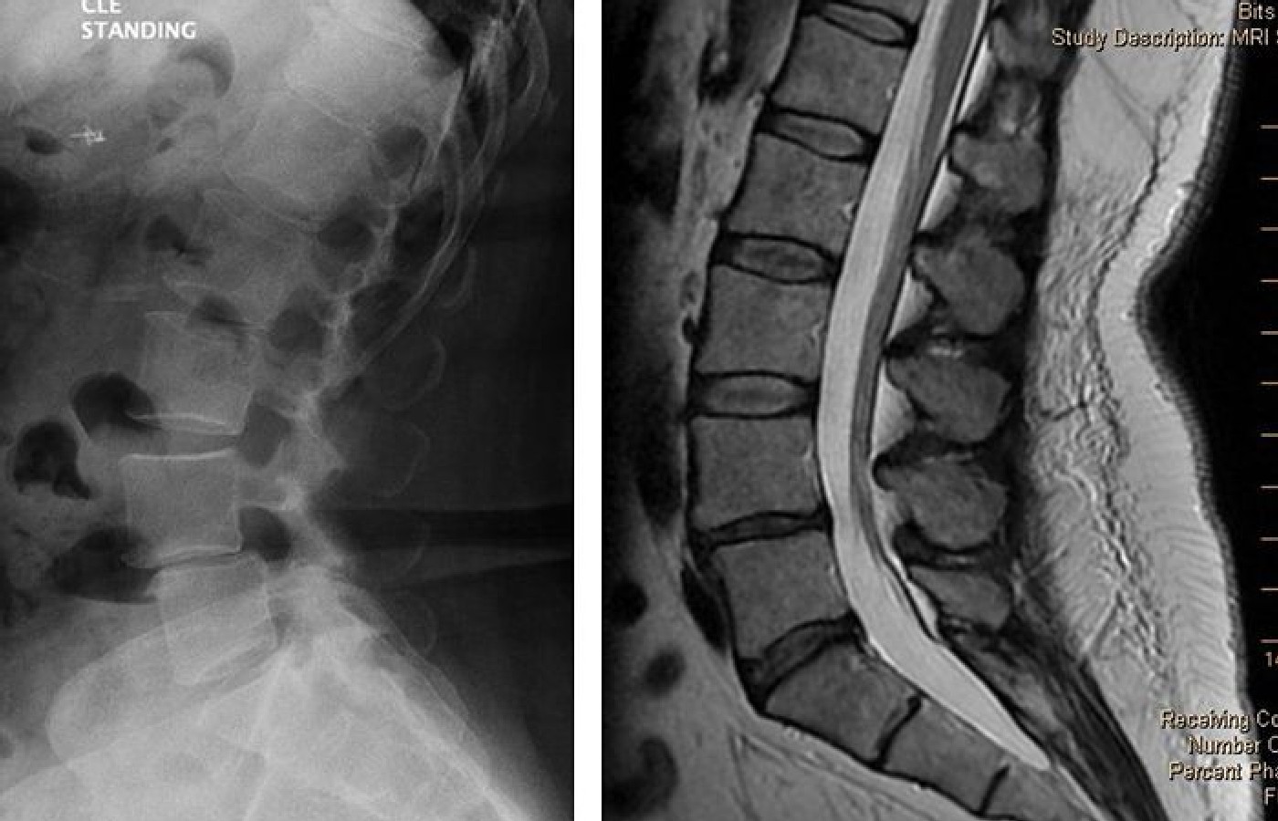 lumbar instability