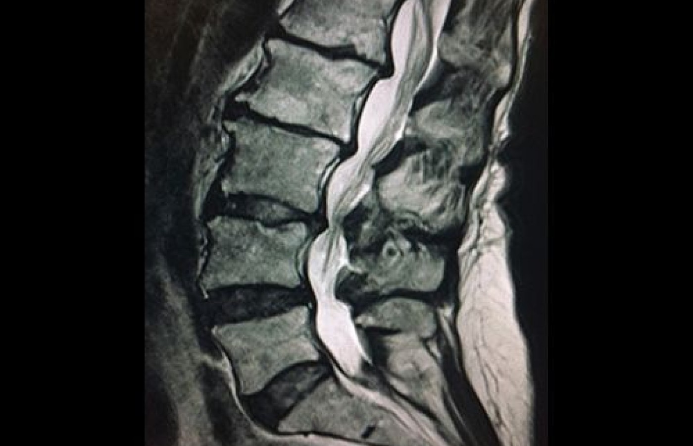 Lumbar Stenosis