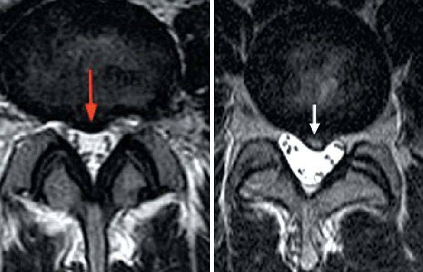 Lumbar Spine