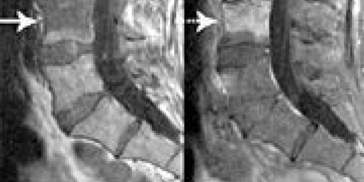 Discitis as a Cause of Lower Back Pain | Dynamic Chiropractic