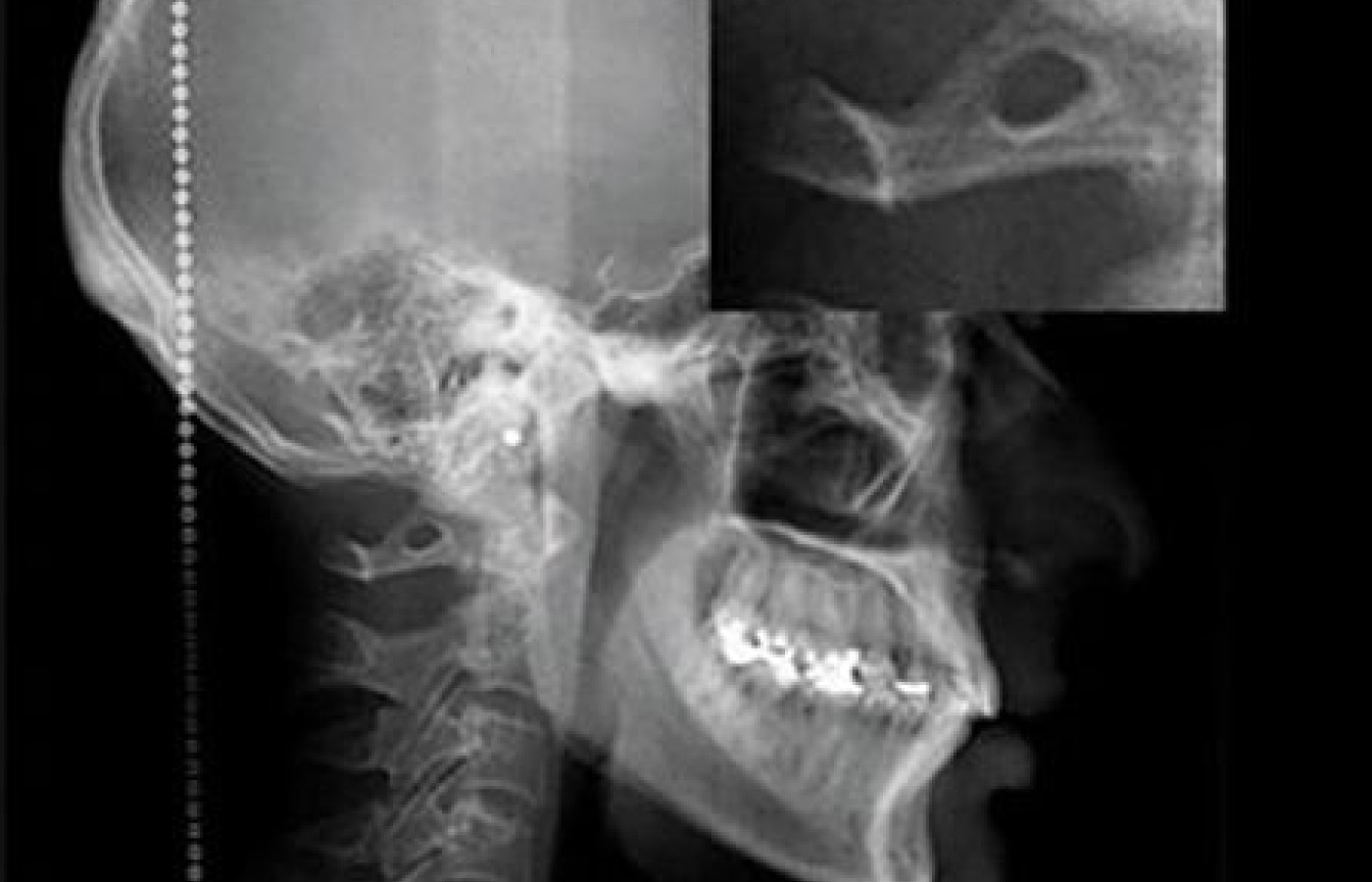 arcuate foramen